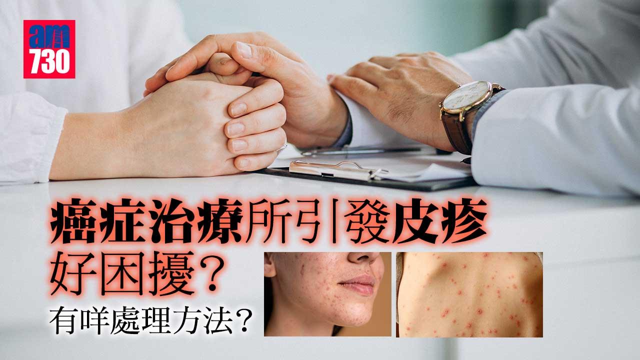 癌症治療所引發皮疹好困擾?有咩處理方法?