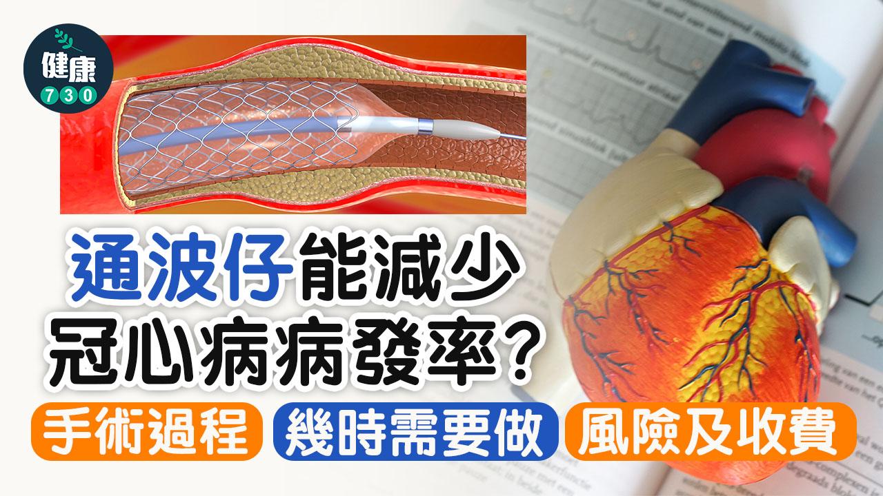 通波仔手術會在冠狀動脈中撐開收窄位置,並置入支架防止血管再次收窄。