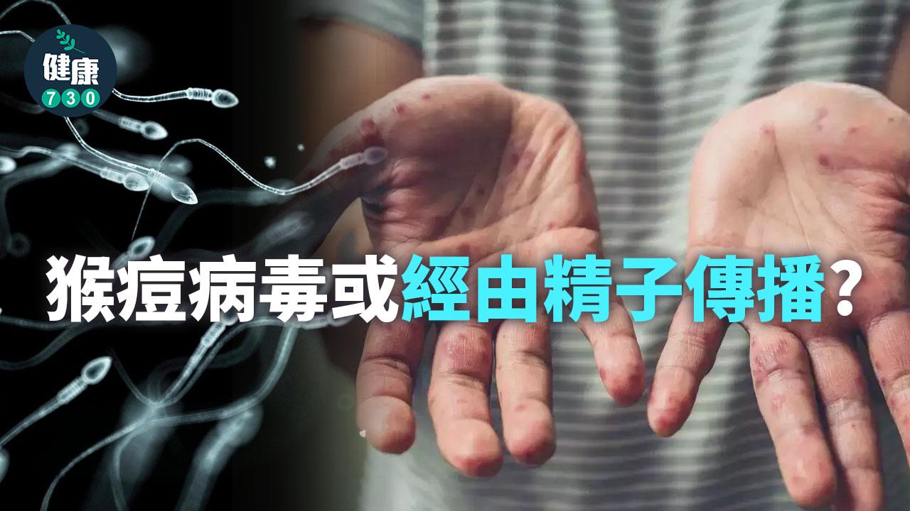 病例持續增加 猴痘病毒或經由精子傳播?