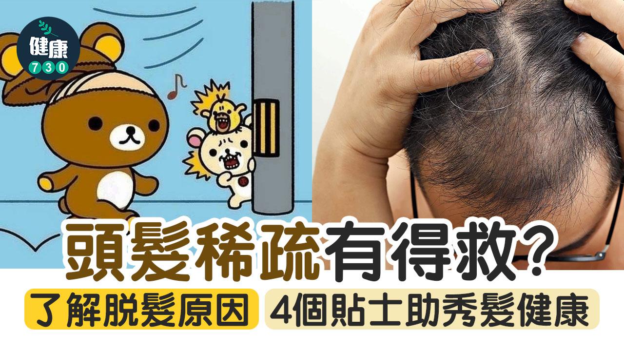 脫髮|頭髮稀疏有得救?