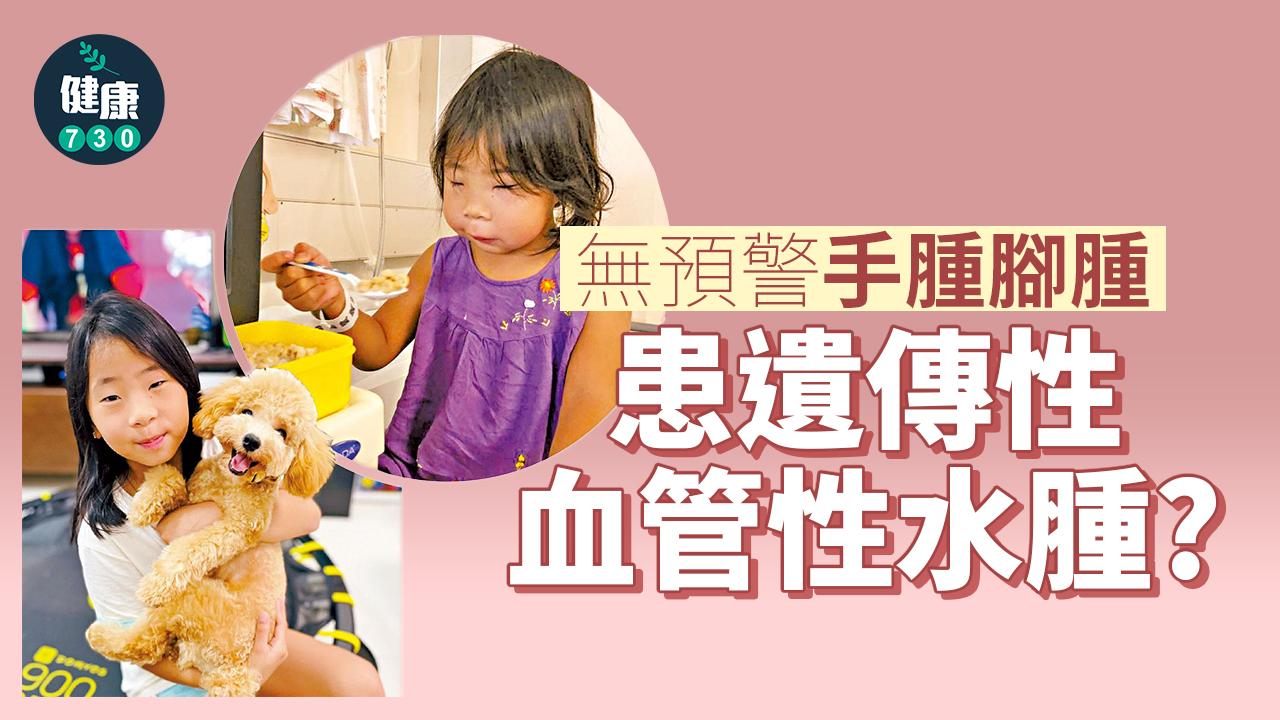 無預警手腫腳腫 患遺傳性血管性水腫?