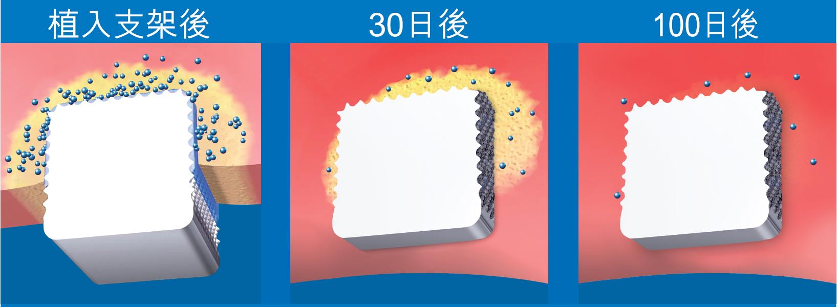 新一代支架表面有些微細小孔,毋須聚合物也能黏附藥物,支架上的藥物會在30日左右完全被血管壁吸收而持續發揮作用,而藥效並能維持大約100天。