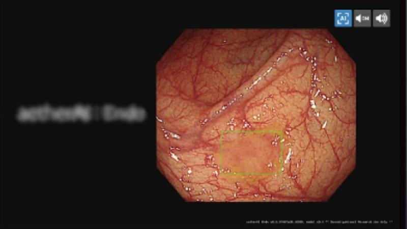 即時大腸鏡息肉自動偵測