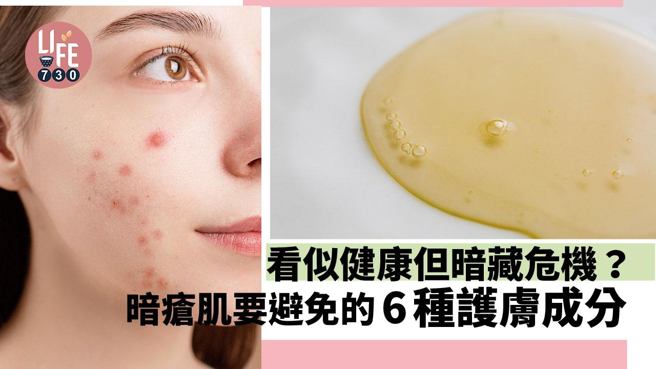 看似天然健康但暗藏危機?暗瘡肌膚要避免的6種護膚成分