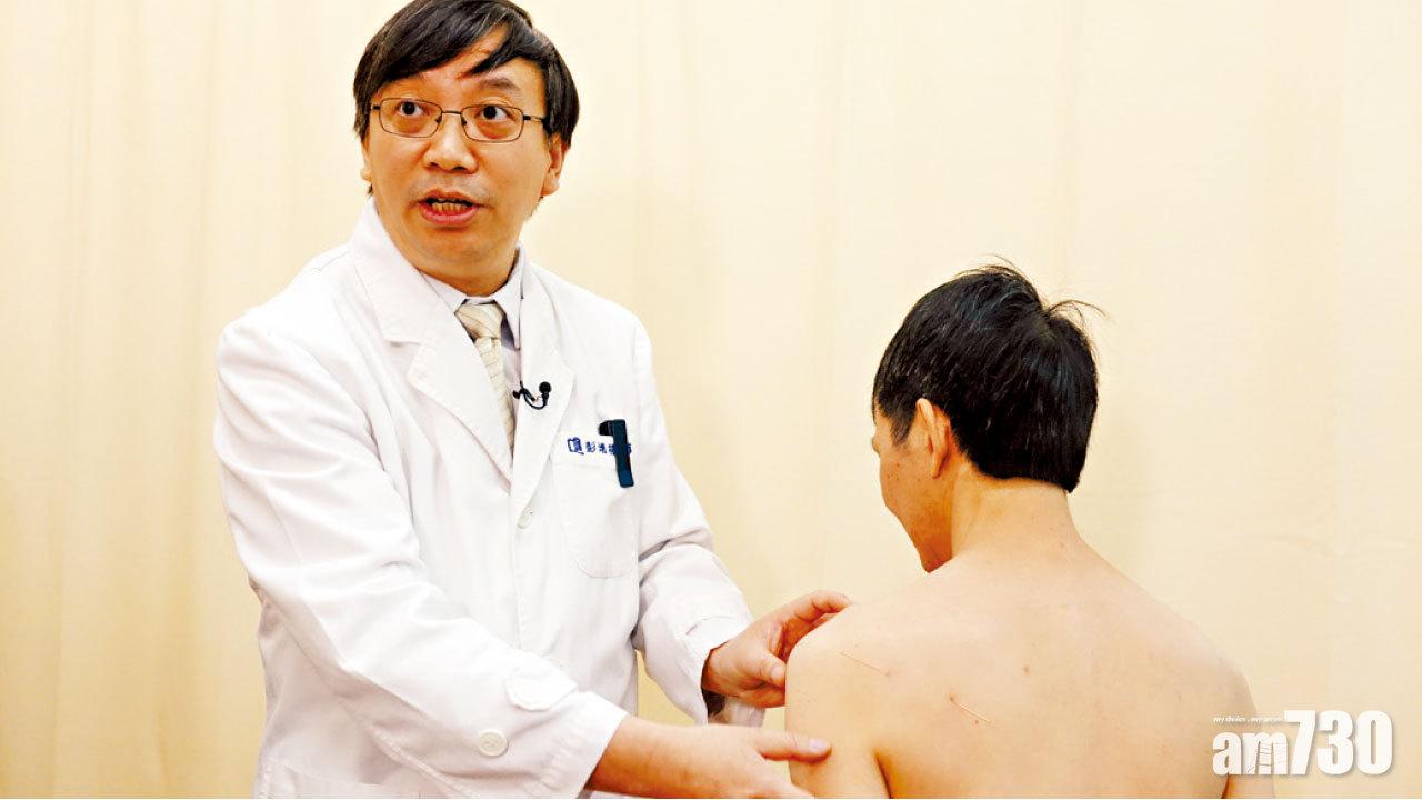 彭增福表示,激痛點針刺療法是對激痛點施行針灸。(李卓謙攝)