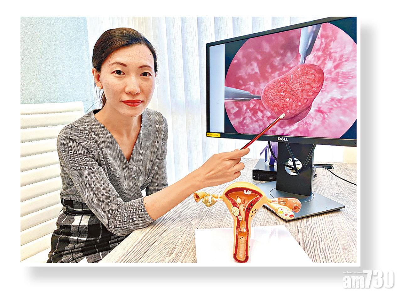 范曉蘭指子宮息肉或肌瘤都可能影響日常生活,女士應定期做婦科檢查,及早發現和處理問題。