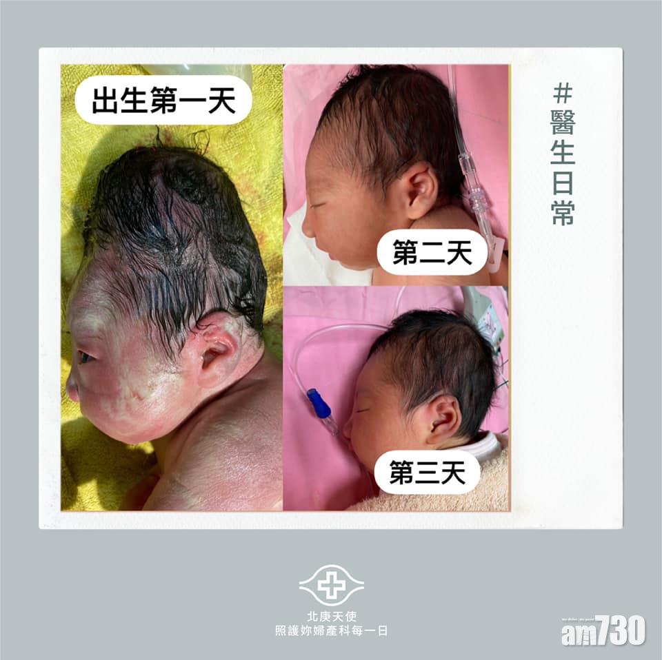 醫生指出寶寶頭型過長的情況會逐漸消退。(台北長庚醫院婦產科fb圖片)