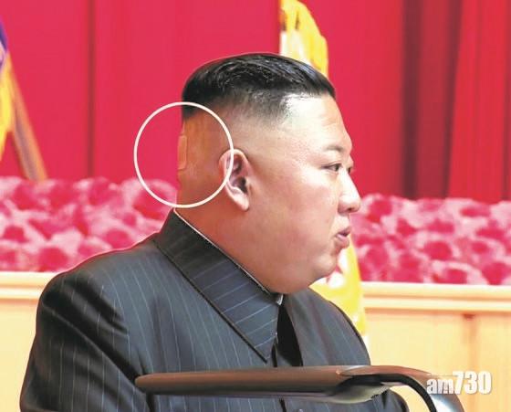 金正恩後腦貼有膠布,再引發健康揣測。(互聯網)