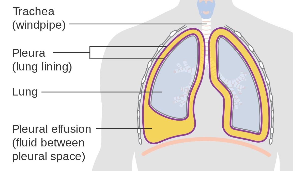 延遲治療肺積水 小心變肺縮水 am730
