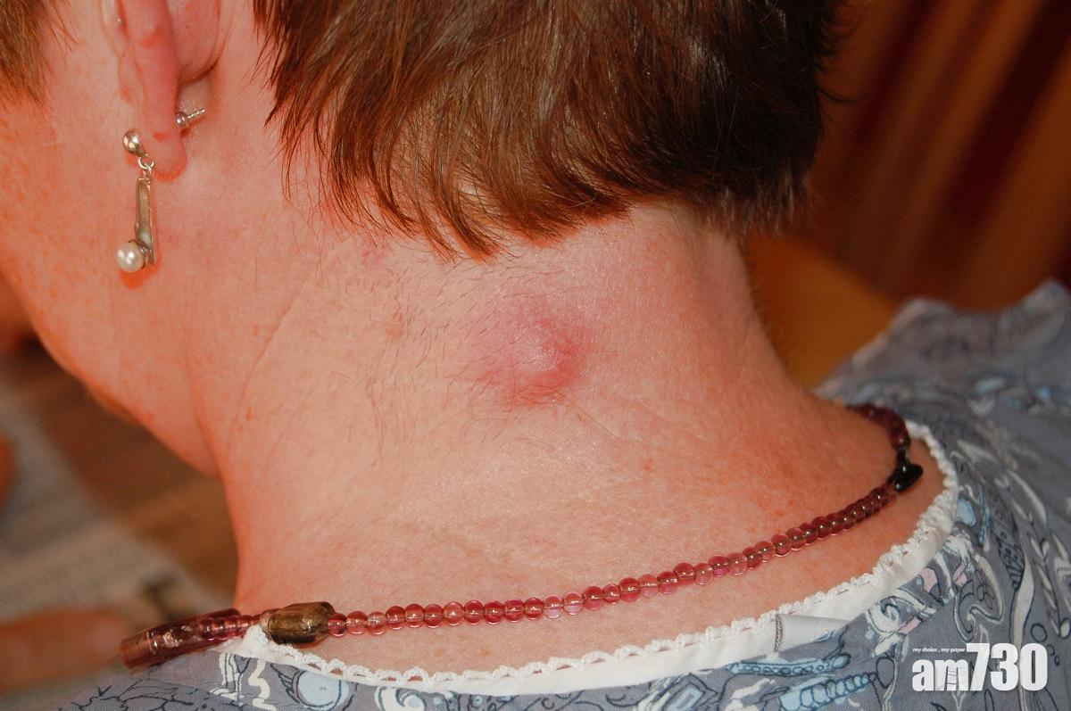 粉瘤 愈擠隨時愈衰 Am730