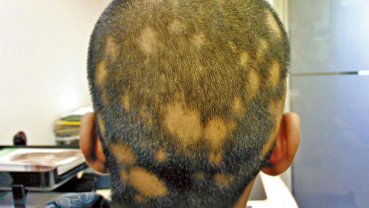 Очаговая алопеция (alopecia areata). Залысины от вырывания волос. Средство от выпадения волос у мужчин миноксидил. Очаговая (гнездная) алопеция. Андрогенетическая алопеция у мужчин.